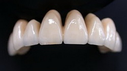 протезирование зубов металлокерамикой